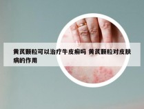 黄芪颗粒可以治疗牛皮癣吗 黄芪颗粒对皮肤病的作用