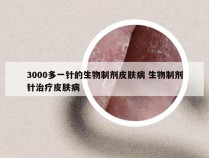 3000多一针的生物制剂皮肤病 生物制剂针治疗皮肤病