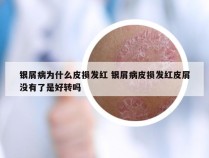 银屑病为什么皮损发红 银屑病皮损发红皮屑没有了是好转吗
