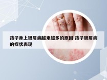 孩子身上银屑病越来越多的原因 孩子银屑病的症状表现