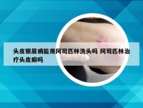 头皮银屑病能用阿司匹林洗头吗 阿司匹林治疗头皮癣吗