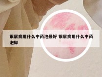 银屑病用什么中药泡最好 银屑病用什么中药泡脚