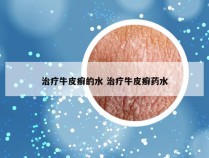 治疗牛皮癣的水 治疗牛皮癣药水