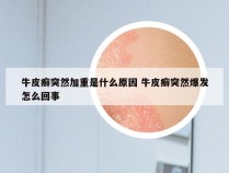 牛皮癣突然加重是什么原因 牛皮癣突然爆发怎么回事