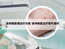 徐州银屑病治疗价格 徐州哪里治疗银牛屑好?