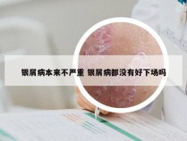 银屑病本来不严重 银屑病都没有好下场吗
