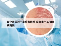 白介素二对牛皮癣有效吗 白介素一17银屑病药物