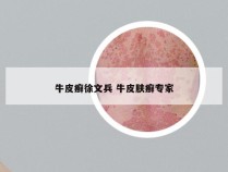 牛皮癣徐文兵 牛皮肤癣专家
