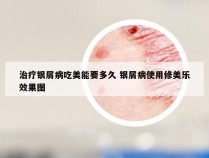 治疗银屑病吃美能要多久 银屑病使用修美乐效果图