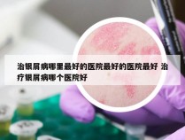 治银屑病哪里最好的医院最好的医院最好 治疗银屑病哪个医院好
