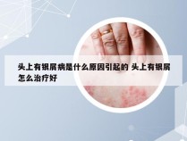 头上有银屑病是什么原因引起的 头上有银屑怎么治疗好