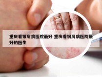 重庆看银屑病医院最好 重庆看银屑病医院最好的医生
