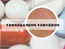 牛皮癣用蒜起水泡能好吗 牛皮廨大蒜能吃吗
