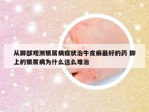 从脚部观测银屑病症状治牛皮癣最好的药 脚上的银屑病为什么这么难治