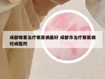 成都哪里治疗银屑病最好 成都市治疗银屑病权威医院