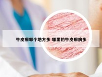 牛皮癣哪个地方多 哪里的牛皮癣病多