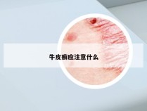 牛皮癣应注意什么