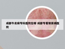 成都牛皮癣专科医院在哪 成都专看银屑病医院