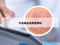 牛皮癣会角质变厚吗
