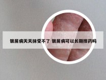 银屑病天天抹受不了 银屑病可以长期擦药吗