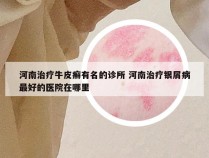 河南治疗牛皮癣有名的诊所 河南治疗银屑病最好的医院在哪里