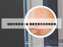 强直和银屑病一起 强直性脊柱炎和银屑病