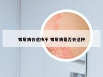 银屑病会遗传不 银屑病是否会遗传