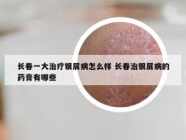 长春一大治疗银屑病怎么样 长春治银屑病的药膏有哪些