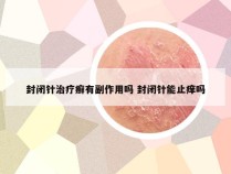 封闭针治疗癣有副作用吗 封闭针能止痒吗