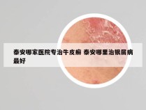 泰安哪家医院专治牛皮癣 泰安哪里治银屑病最好