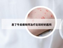 患了牛皮癣如何治疗比较好的医院