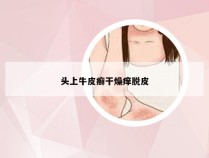 头上牛皮癣干燥痒脱皮