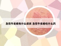 急性牛皮癣有什么症状 急性牛皮癣吃什么药