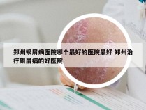 郑州银屑病医院哪个最好的医院最好 郑州治疗银屑病的好医院