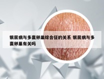 银屑病与多囊卵巢综合征的关系 银屑病与多囊卵巢有关吗