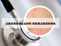 过敏性银屑病能治好吗 银屑病过敏源有哪些