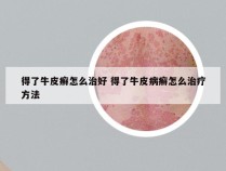 得了牛皮癣怎么治好 得了牛皮病癣怎么治疗方法