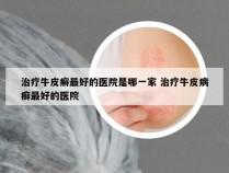 治疗牛皮癣最好的医院是哪一家 治疗牛皮病癣最好的医院