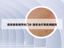 西安银屑病专科门诊 西安治疗银屑病医院