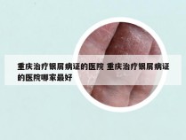 重庆治疗银屑病证的医院 重庆治疗银屑病证的医院哪家最好