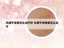 头部牛皮癣怎么治疗好 头部牛皮肤癣怎么治疗
