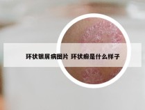 环状银屑病图片 环状癣是什么样子