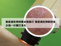 银屑病生物剂要去哪里打 银屑病生物制剂多少钱一针要打多久