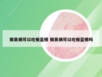 银屑病可以吃板蓝根 银屑病可以吃板蓝根吗