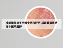 成都银屑病手术哪个医院好啊 成都看银屑病哪个医院最好