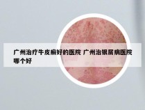 广州治疗牛皮癣好的医院 广州治银屑病医院哪个好