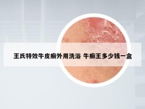王氏特效牛皮癣外用洗浴 牛癣王多少钱一盒