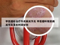 甲氨蝶呤治疗牛皮癣关节炎 甲氨蝶呤银屑病关节炎多长时间见效