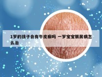 1岁的孩子会有牛皮癣吗 一岁宝宝银屑病怎么治