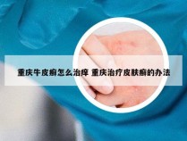重庆牛皮癣怎么治痒 重庆治疗皮肤癣的办法